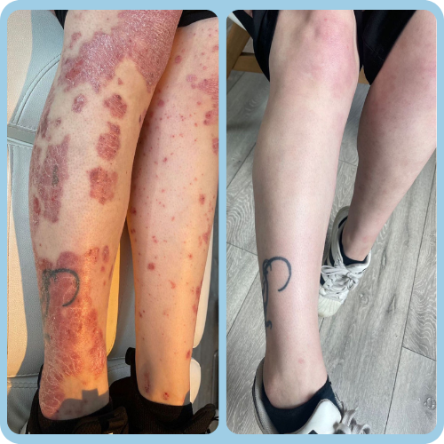 Eczema_Before_and_After