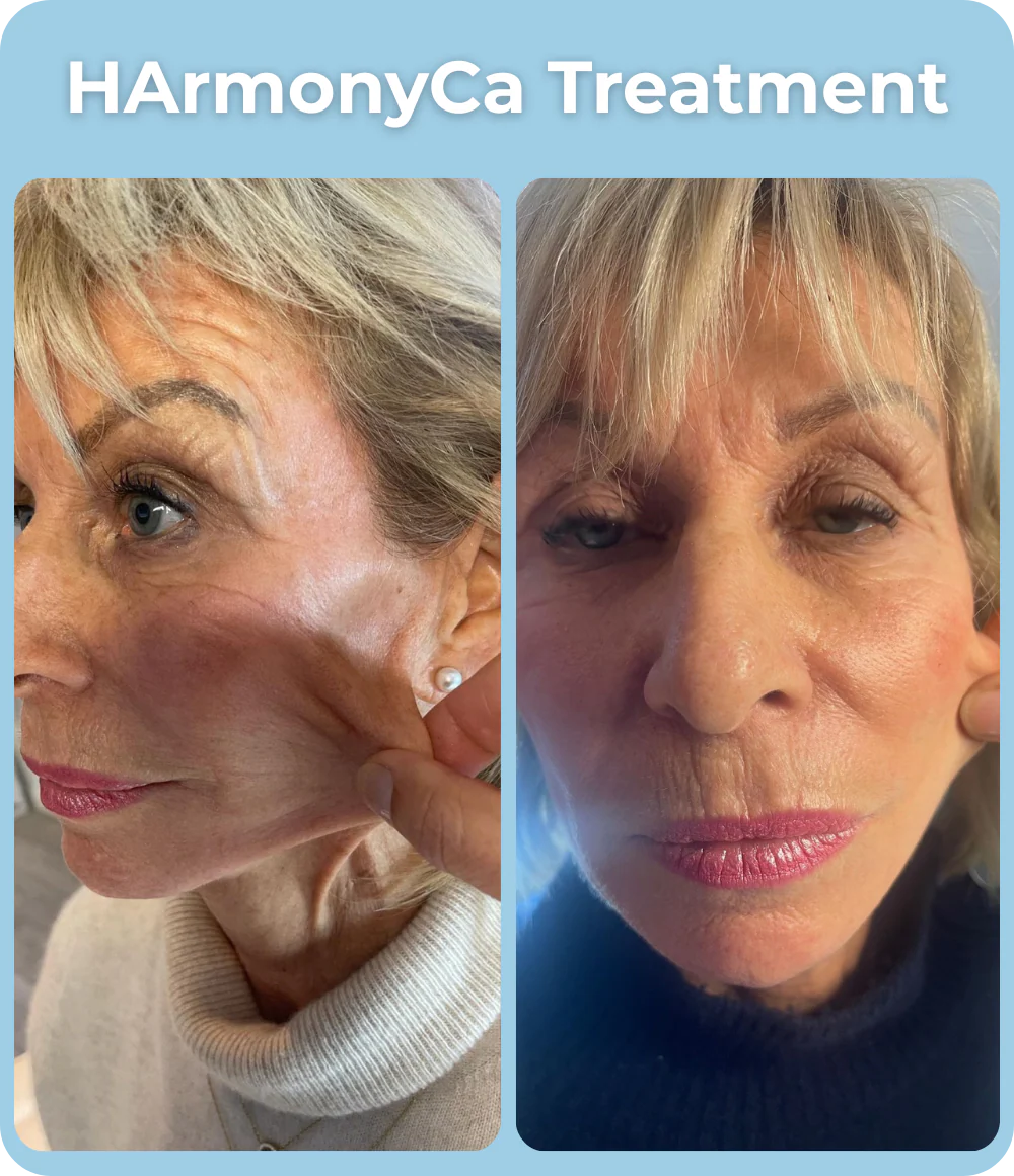 HArmonyCa_Treatment_Before_and_After_-_The_Skin_Investment_Clinic_Farnham_Surrey_-_Aesthetics