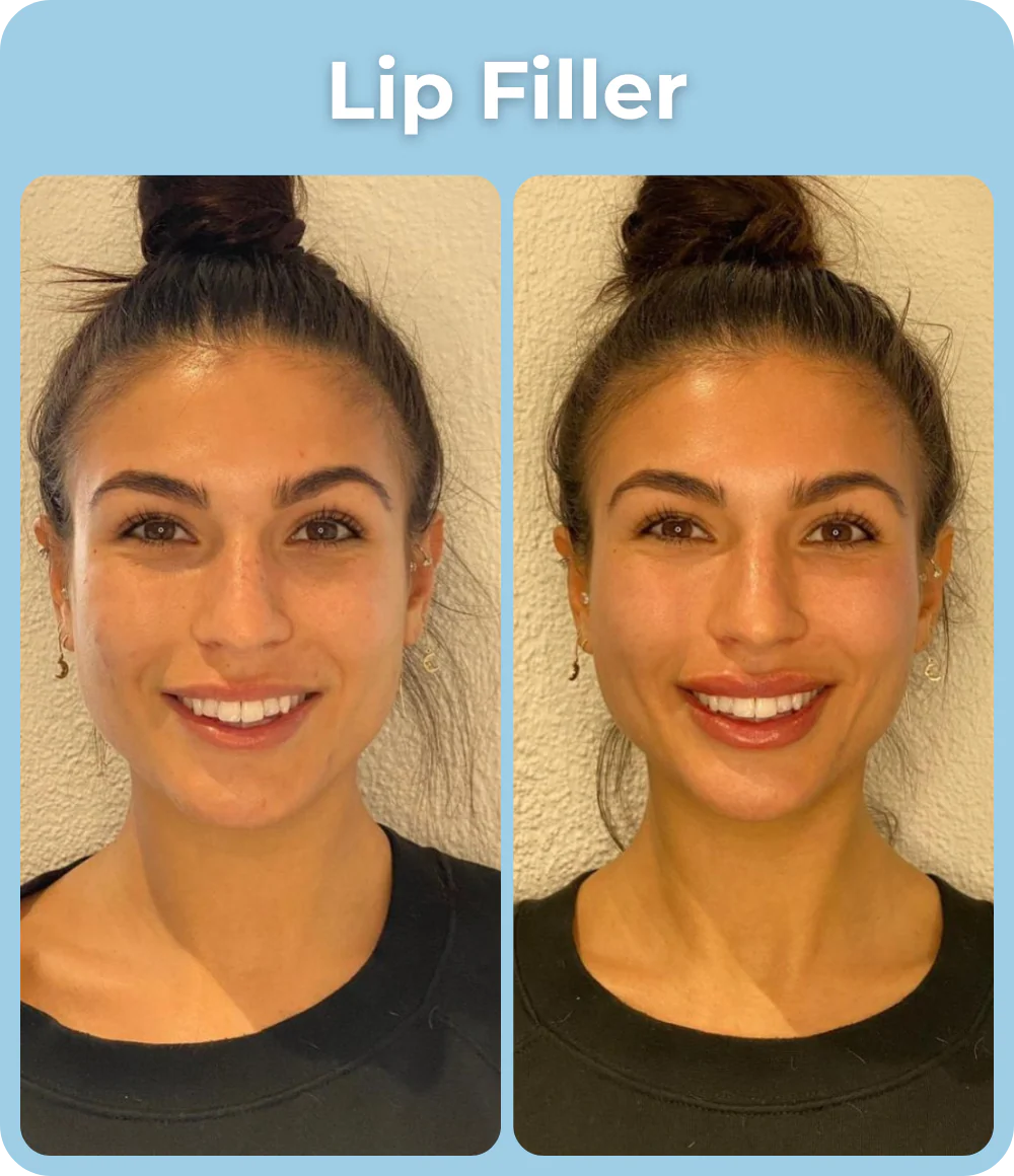 Lip_Filler_Before_and_After_-_The_Skin_Investment_Clinic_Farnham_Surrey_-_Aesthetics_and_Injectables