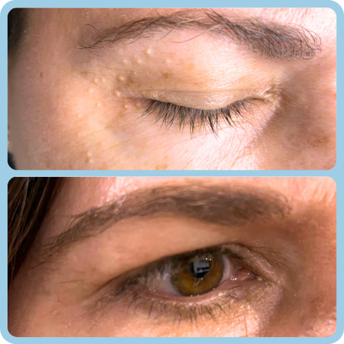 Milia_Removal_Before_and_After