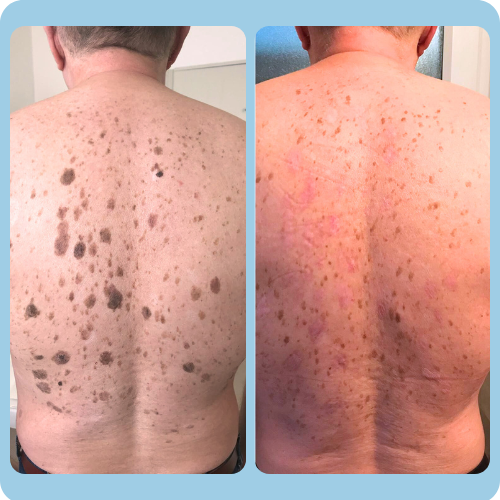 Mole_Removal_Before_and_After