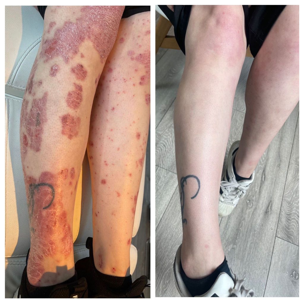 Psoriasis