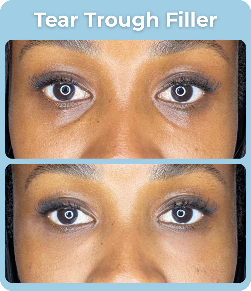 Tear_Trough_Filler_-_The_Skin_Investment_Clinic_Farnham_Surrey_-_Aesthetics_and_Injectables_1