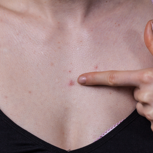 Acne Vulgaris