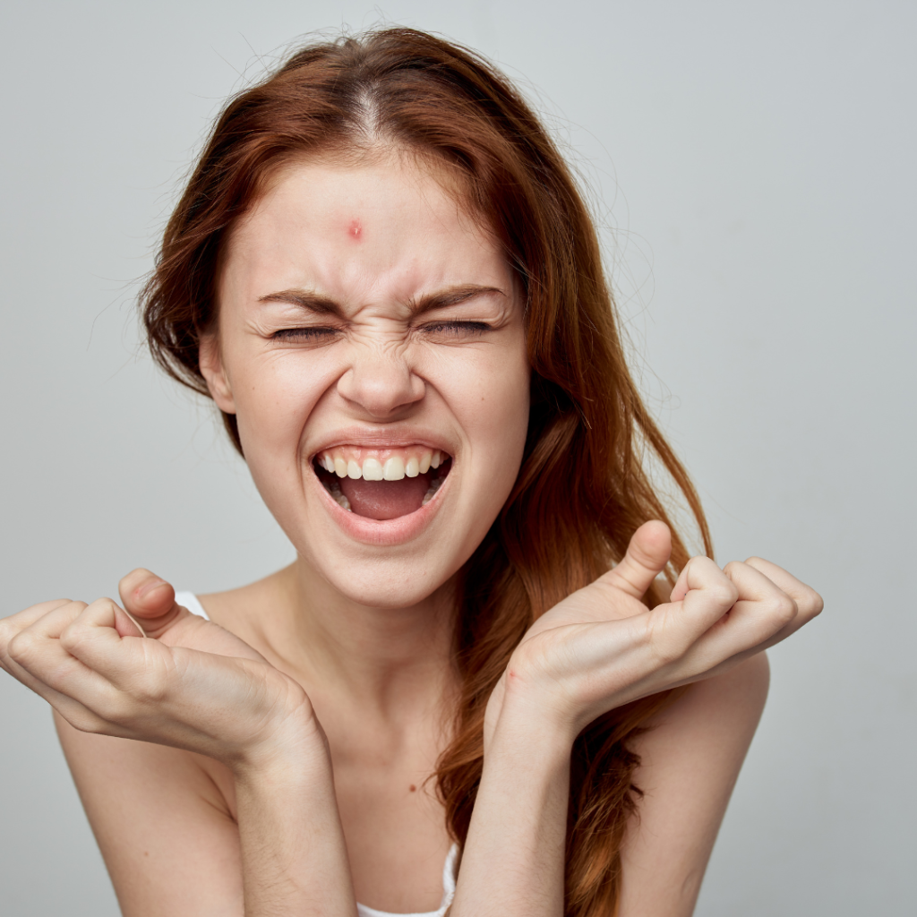 Adult Acne: How to prevent Flare-Ups 1 Acne Flare up