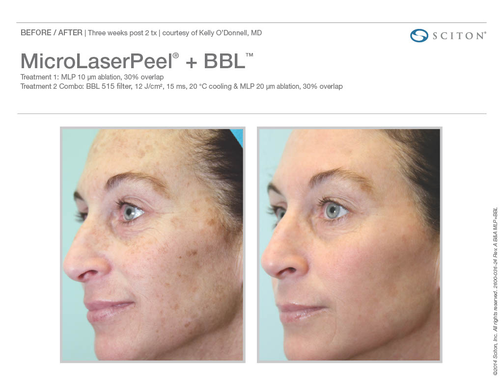 Micro Laser Peel before and after