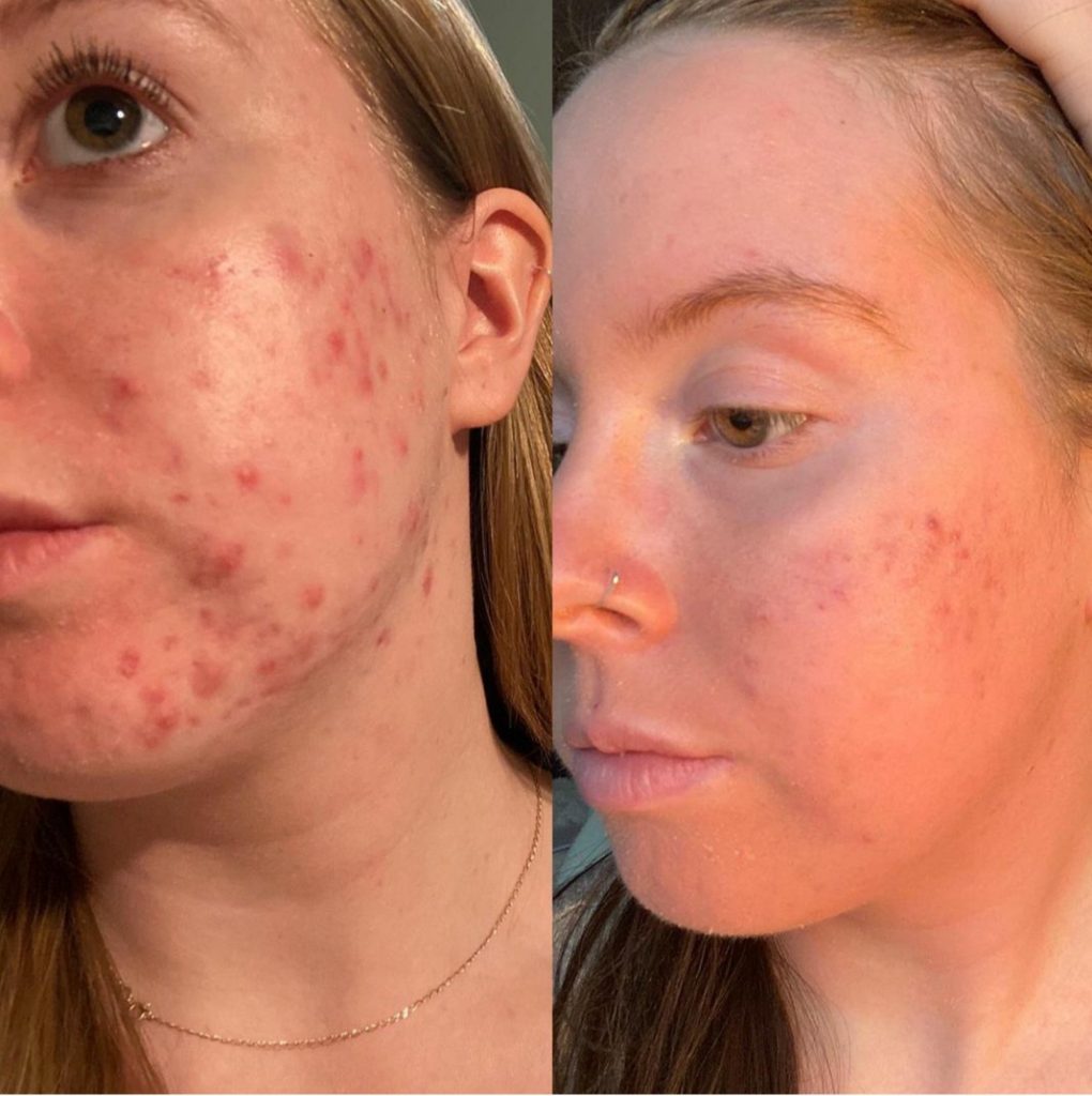 Acne Before and after