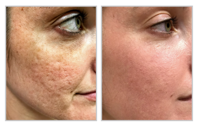 Acne Scarring Resurfacing