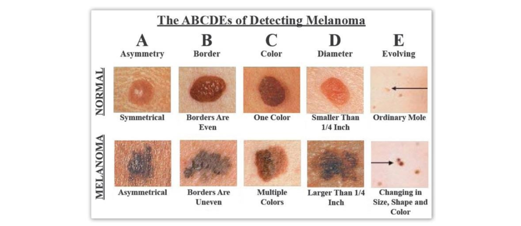 Skin Cancer