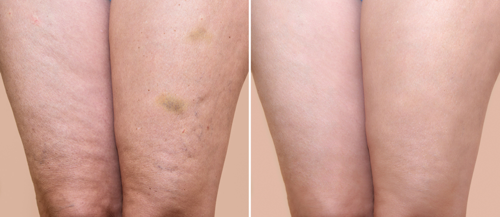 Mesotherapy Cellulite 1 Mesotherapy for Cellulite