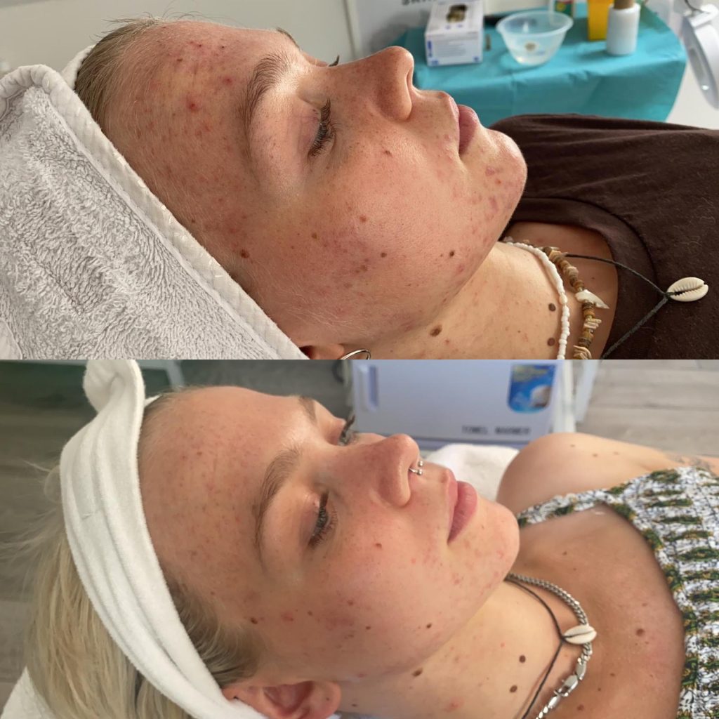 Acne Before and aFter