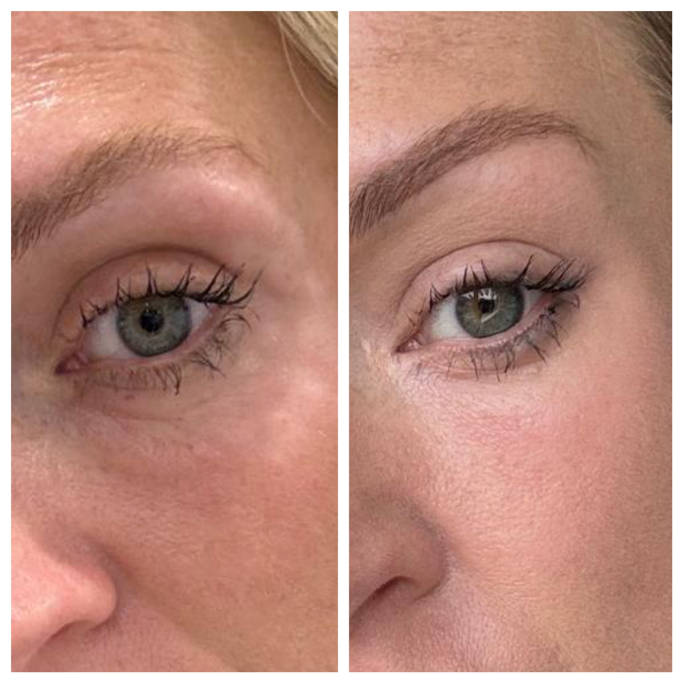 Polynucleotides at The Skin Investment Clinic