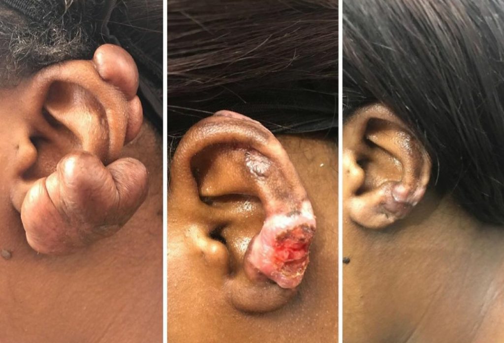 Keloid Removal