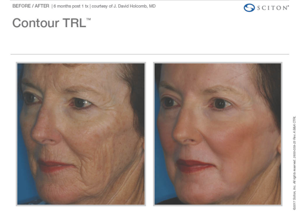 Laser Before and After 2 e1762506787611