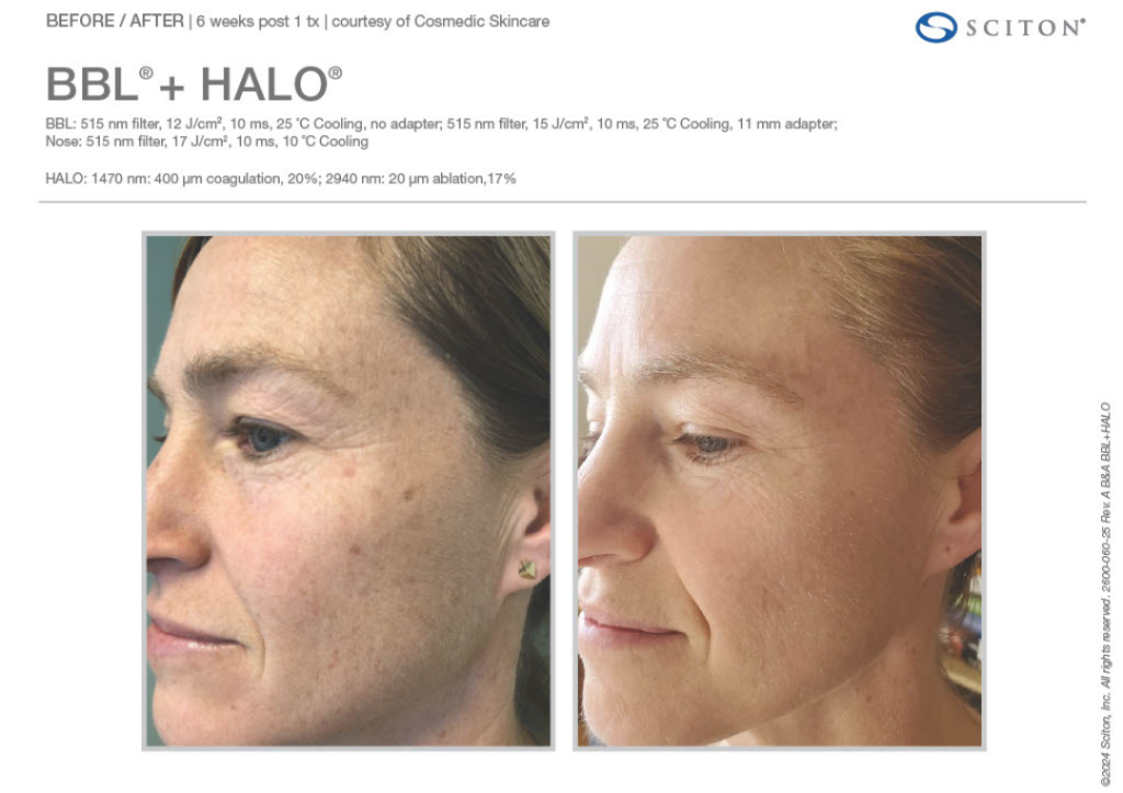 Laser Before and After 3 e1762508681906