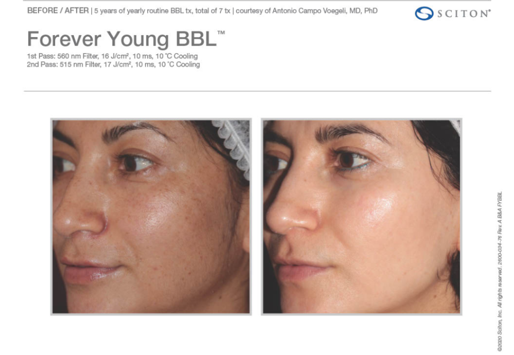 Laser Before and After 6 e1762511921796