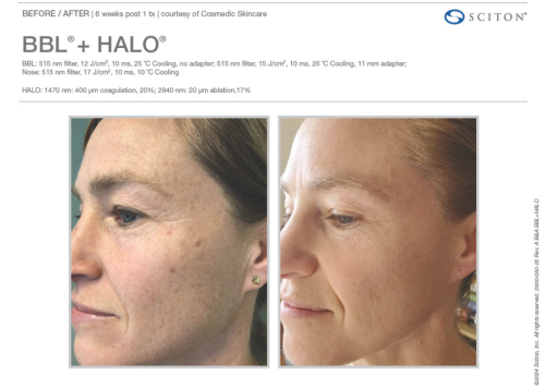 Halo and BBL Laser Treatment