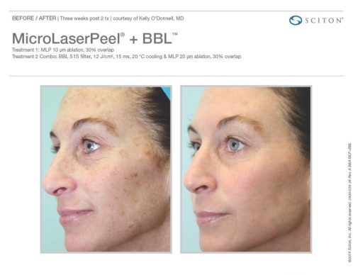 mICROLASER PEEL BEFORE AND AFTER