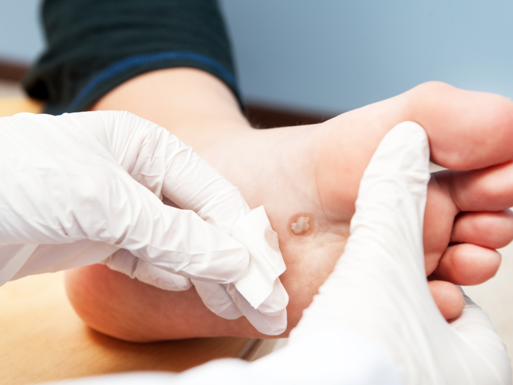 Wart and Verruca Removal 1 Verruca removal