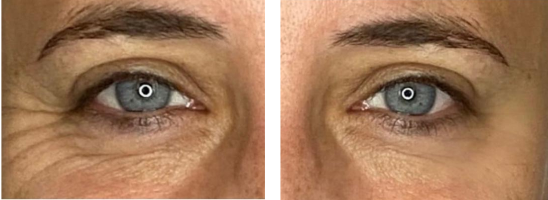 Anti Wrinkle before and after