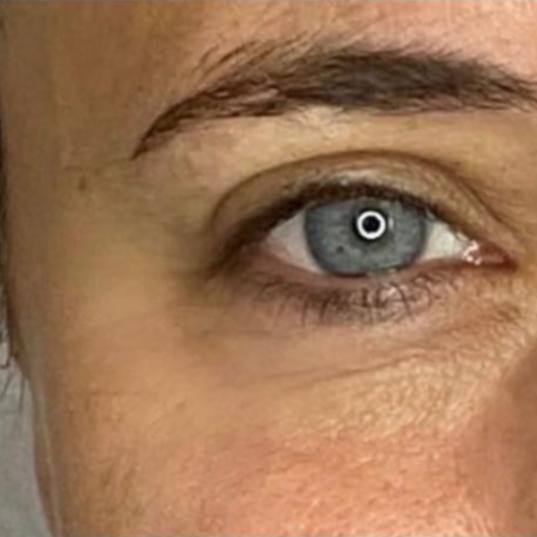 after Anti Wrinkle Injections at The Skin Investment Clinic