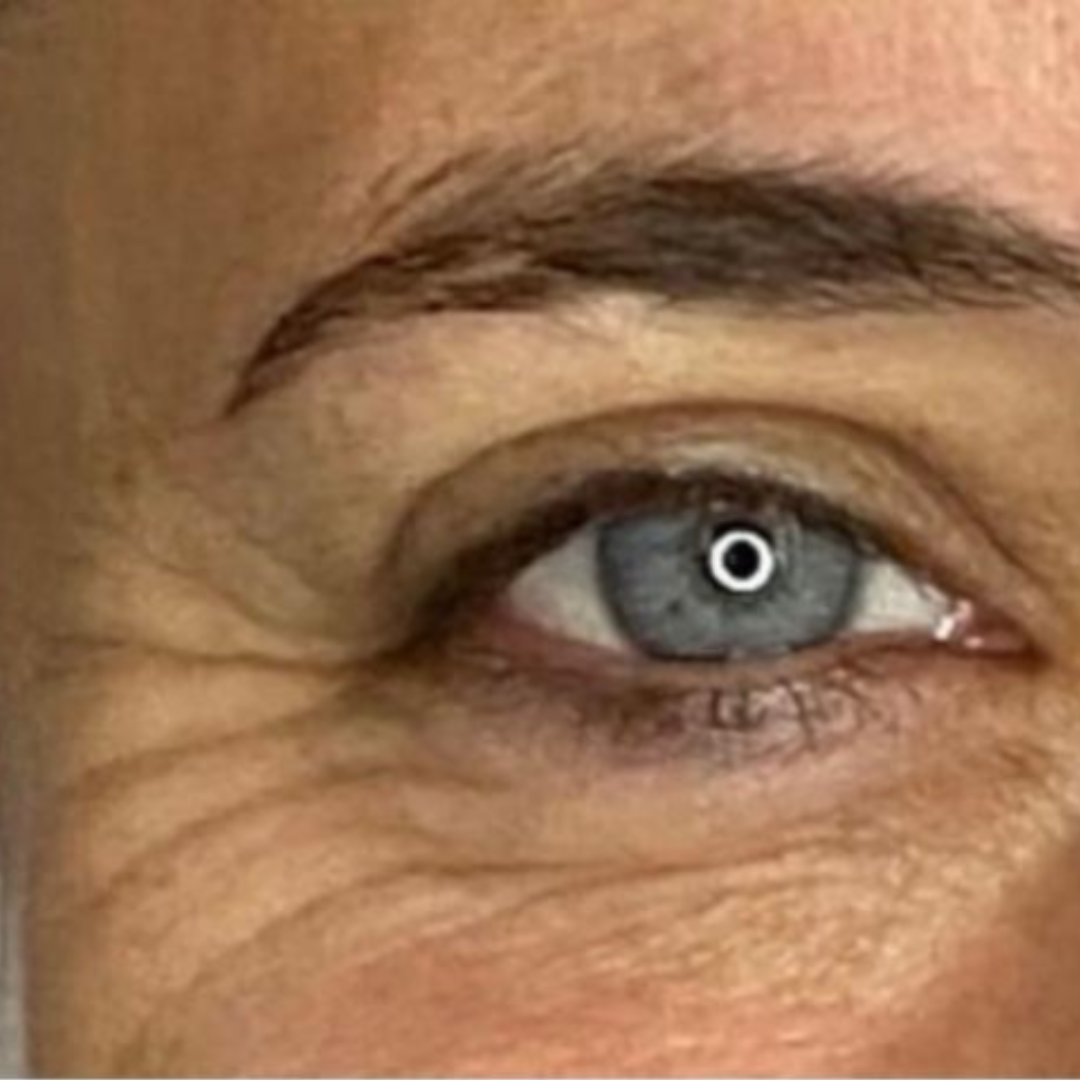 Anti Wrinkle Injections at The Skin Investment Clinic