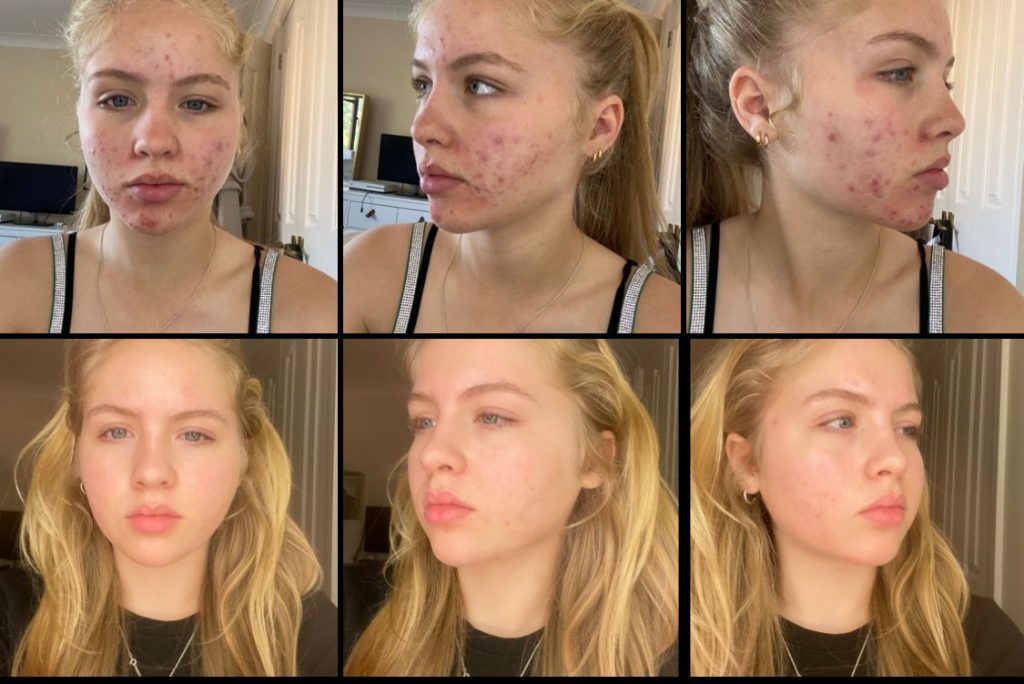 Brinley Acne Before and After