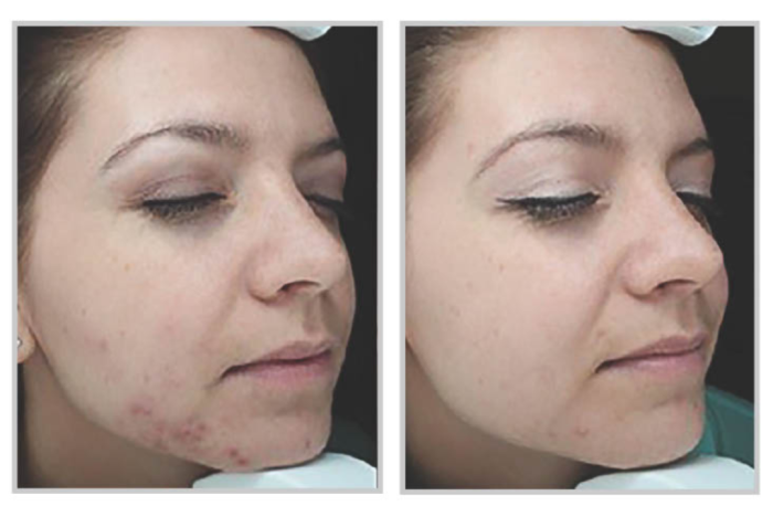 BBL Forever Clear for Acne