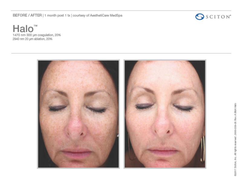 Halo Laser Treatment: Pigmentation