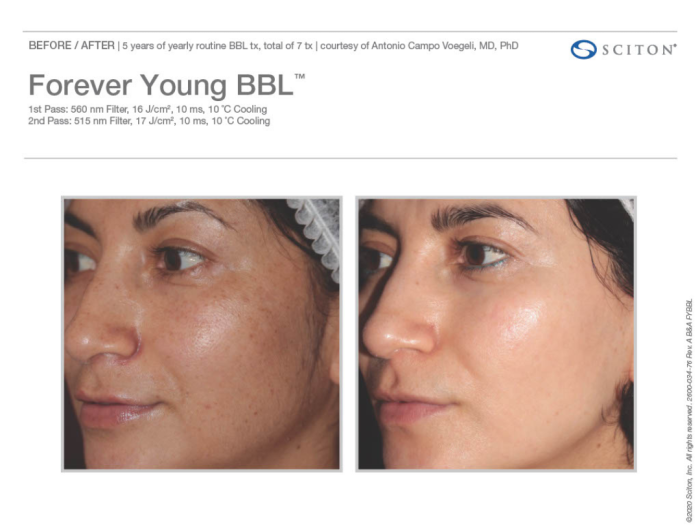 BBL HEro for Pigmenation