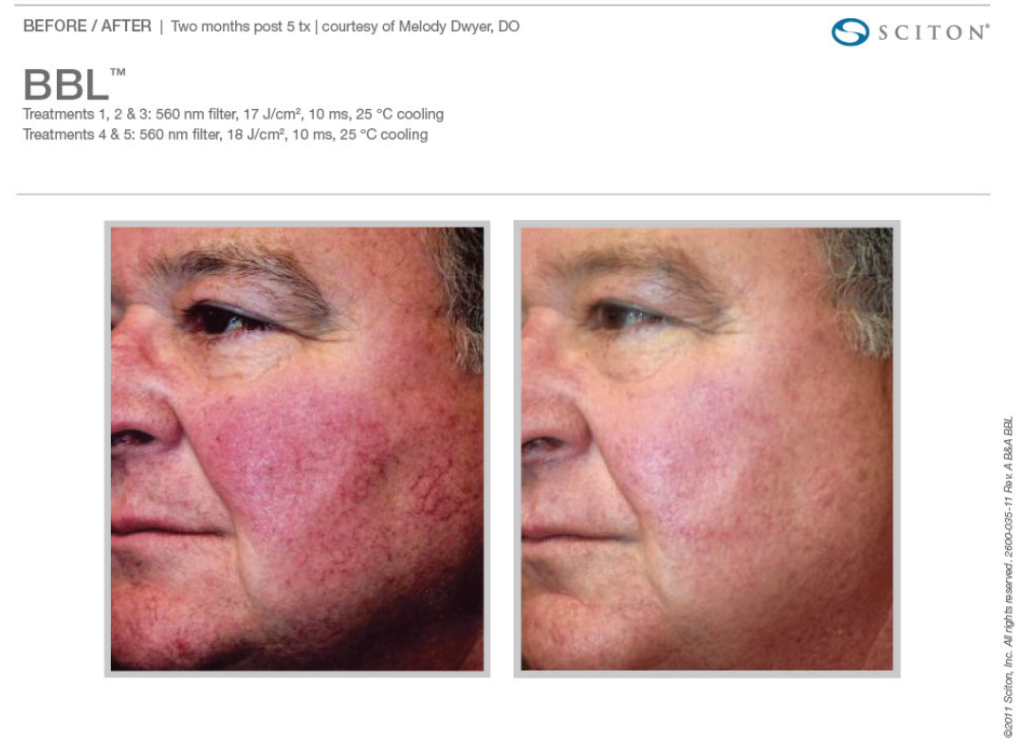 BBL LAser Treatment for Rosacea