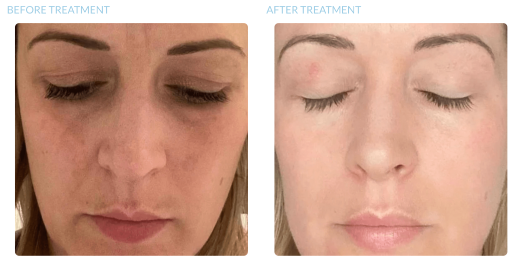 chemical peel before after