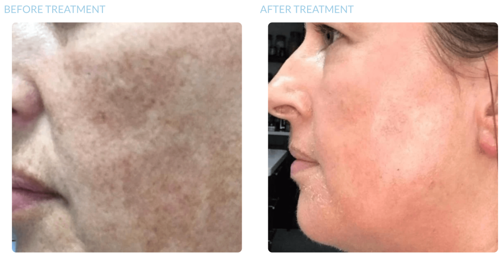 cosmelan peel treatment before after