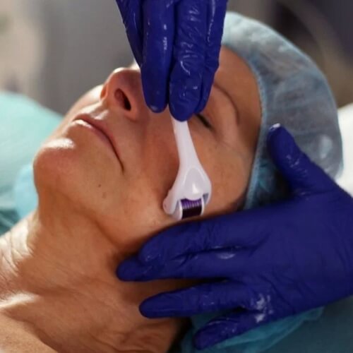 micro needling treatments