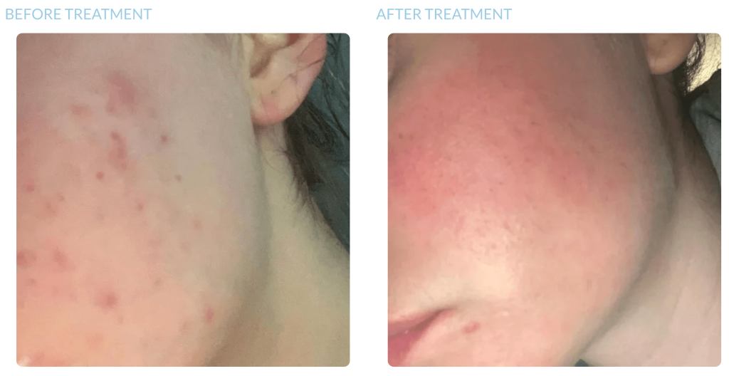 microdermabrasion treatment