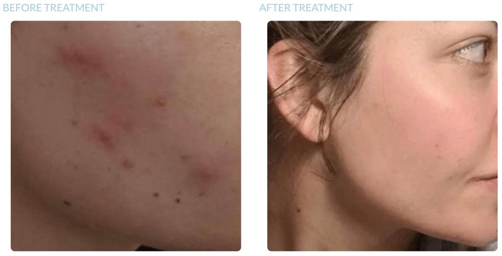 microneedling before after