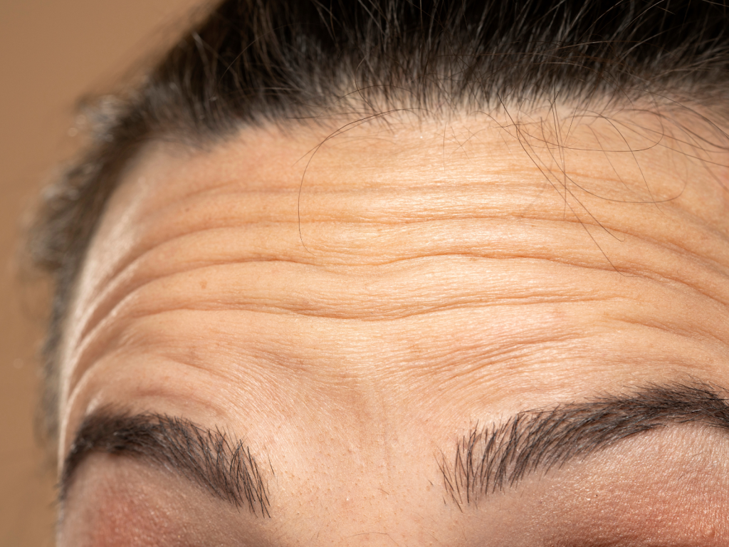 fine lines and wrinkles